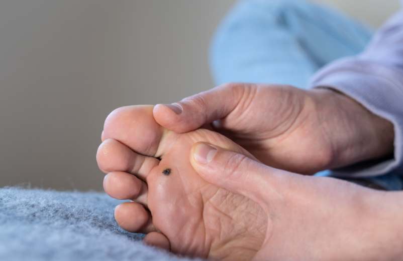 À quoi ressemble une verrue plantaire morte ? À quoi ressemble une verrue plantaire morte ?